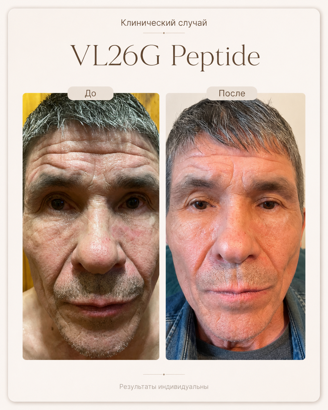 VL26G Peptide — результат после одного применения