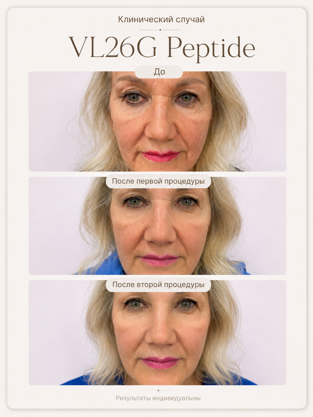 VL26G Peptide — результат после первой и второй процедур