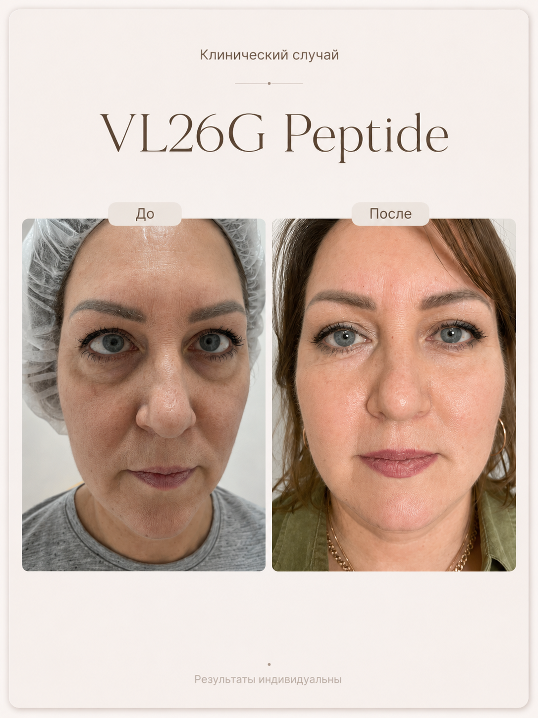 VL26G Peptide — фронтальный результат через одну неделю