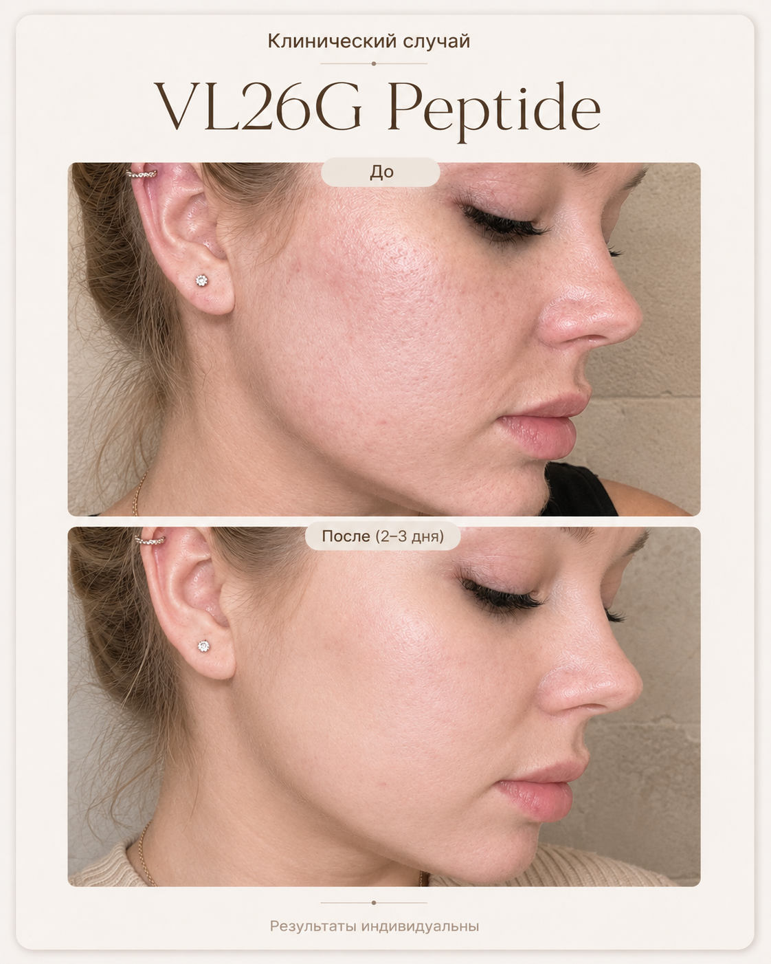 VL26G Peptide — результат через 2–3 дня