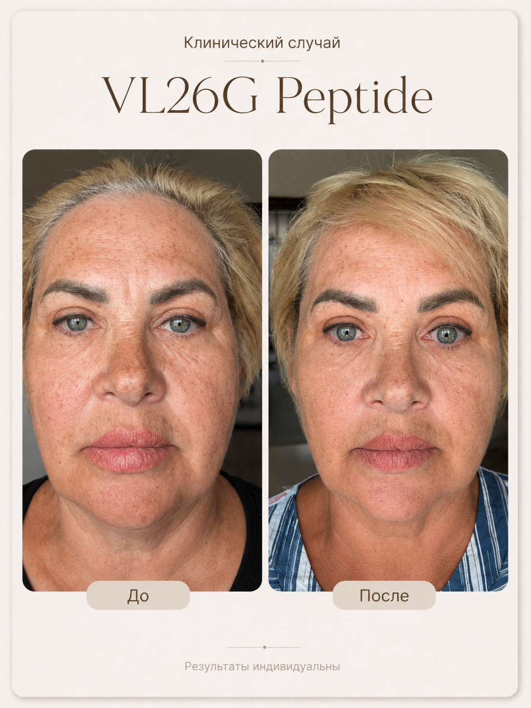 VL26G Peptide — результат после двух процедур